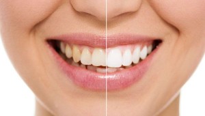 Teeth Whitening in ottawa
