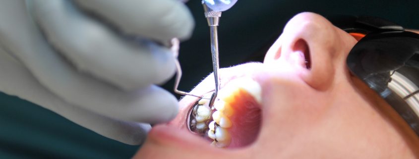 DENTIST IN OTTAWA About Cavities