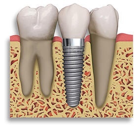 DENTIST IN OTTAWA Dental Implants
